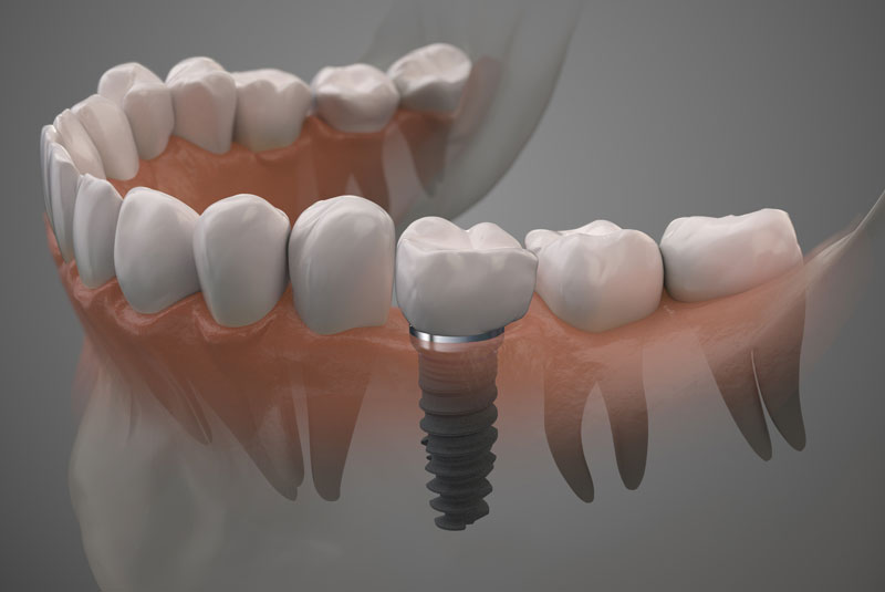 Why Choose Implant Supported Dentures In Fort Lauderdale, FL Over Traditional Dentures?