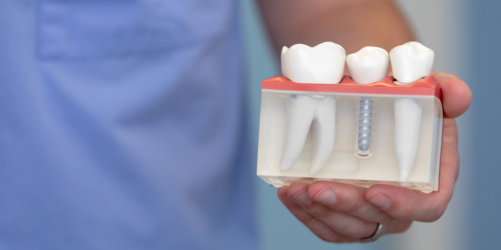 dental implants model