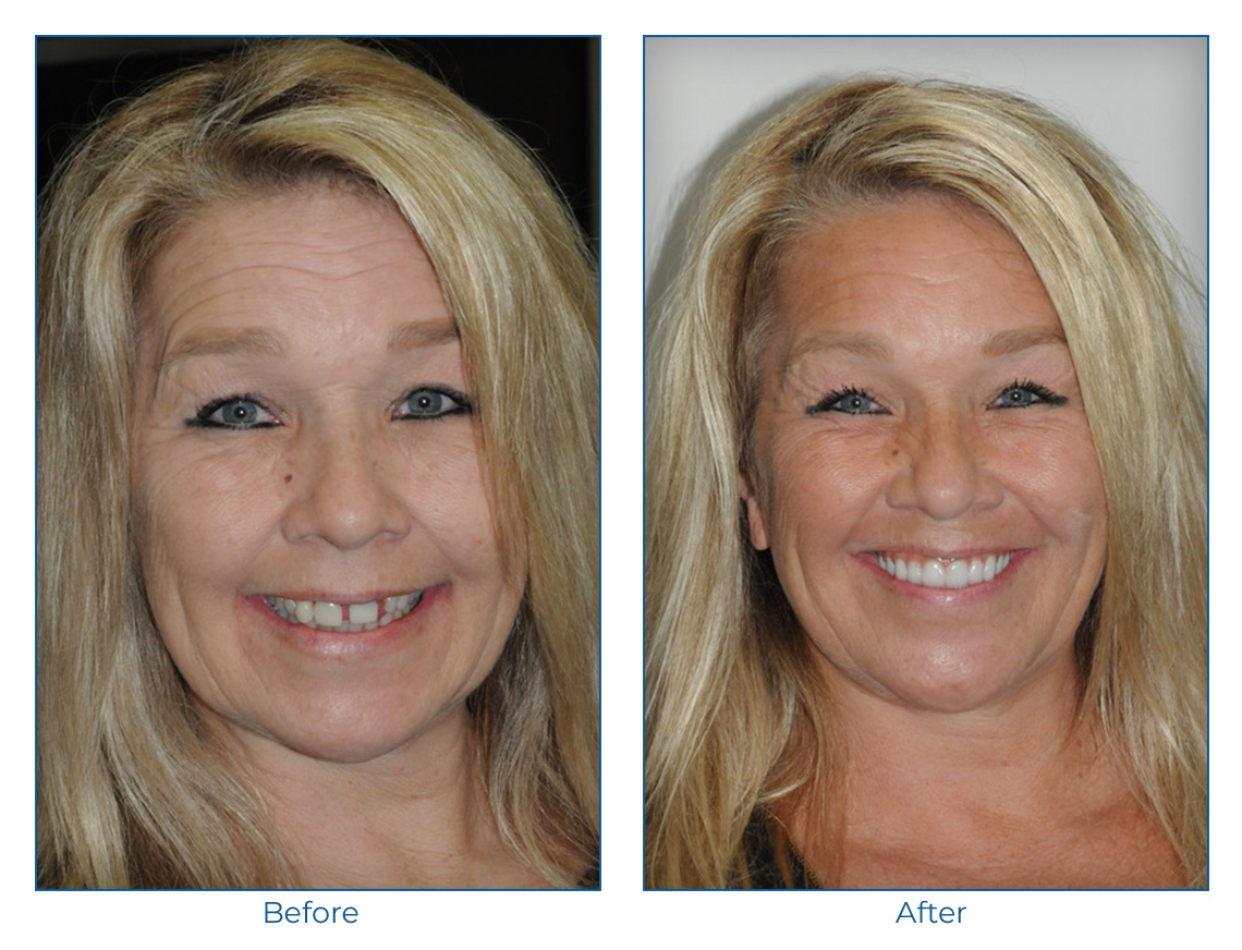 In A Day Smile Dental Implant Seminars Fort Lauderdale