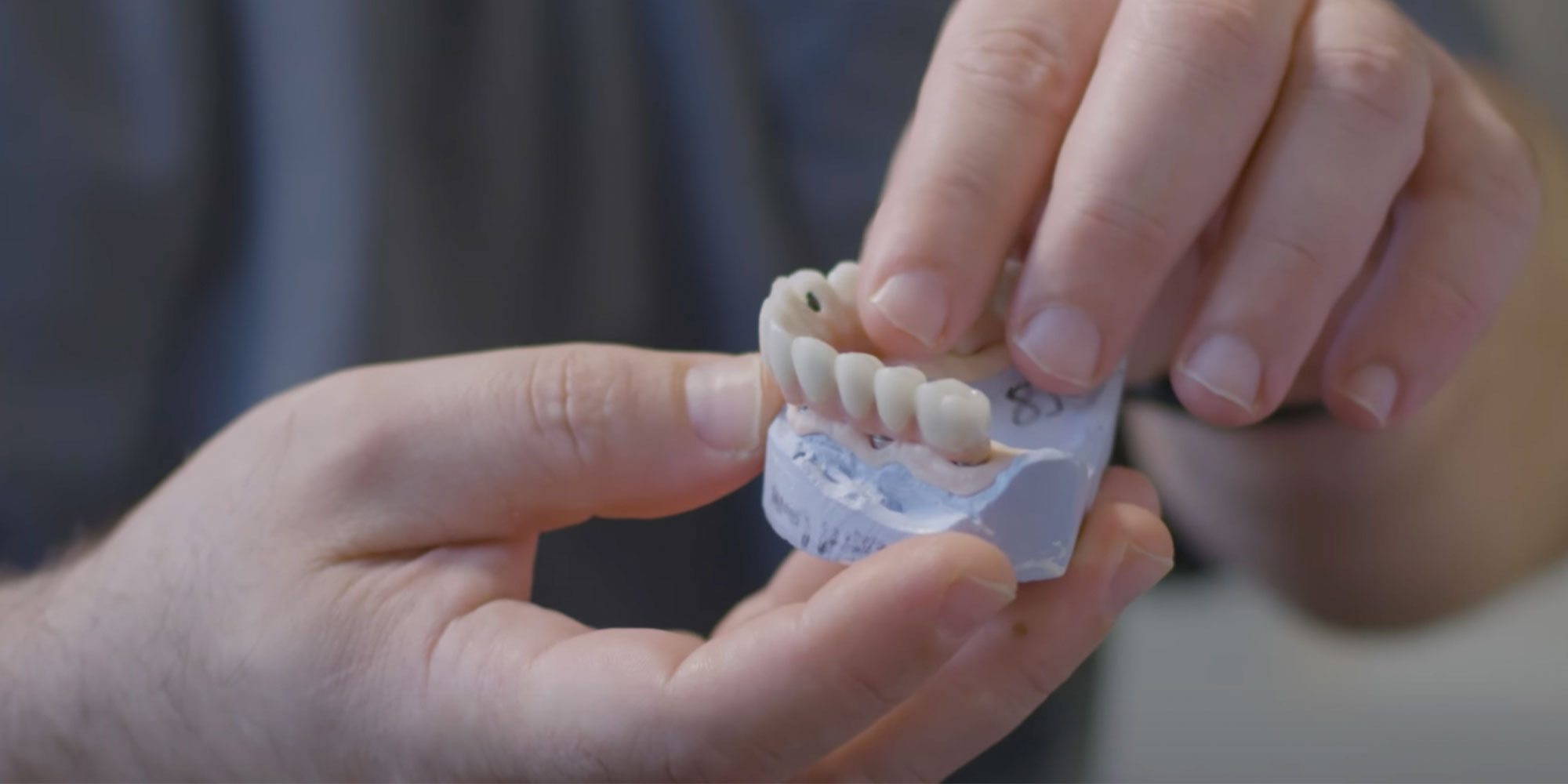 in a day implants