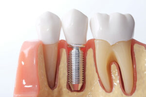 a dental implant model showing a dental implant post and crown.