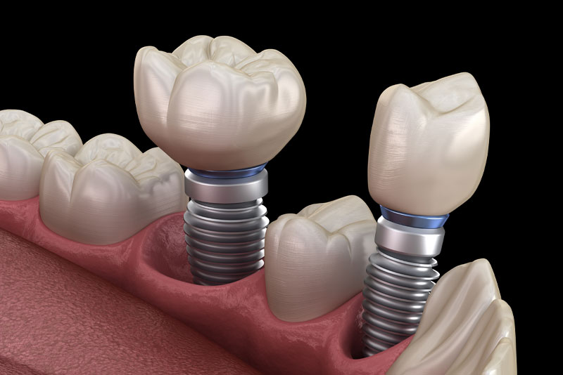 Are There Aesthetic And Functional Benefits To Getting Treated With Multiple Dental Implants?