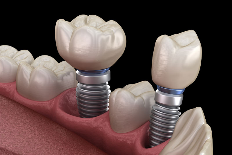 a digital model of a lower jaw showing two o dental implant posts.