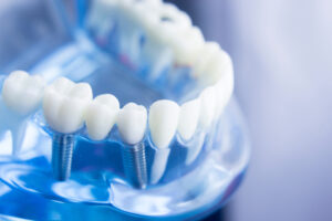 an image of a dental implant in Fort Lauderdale, FL.