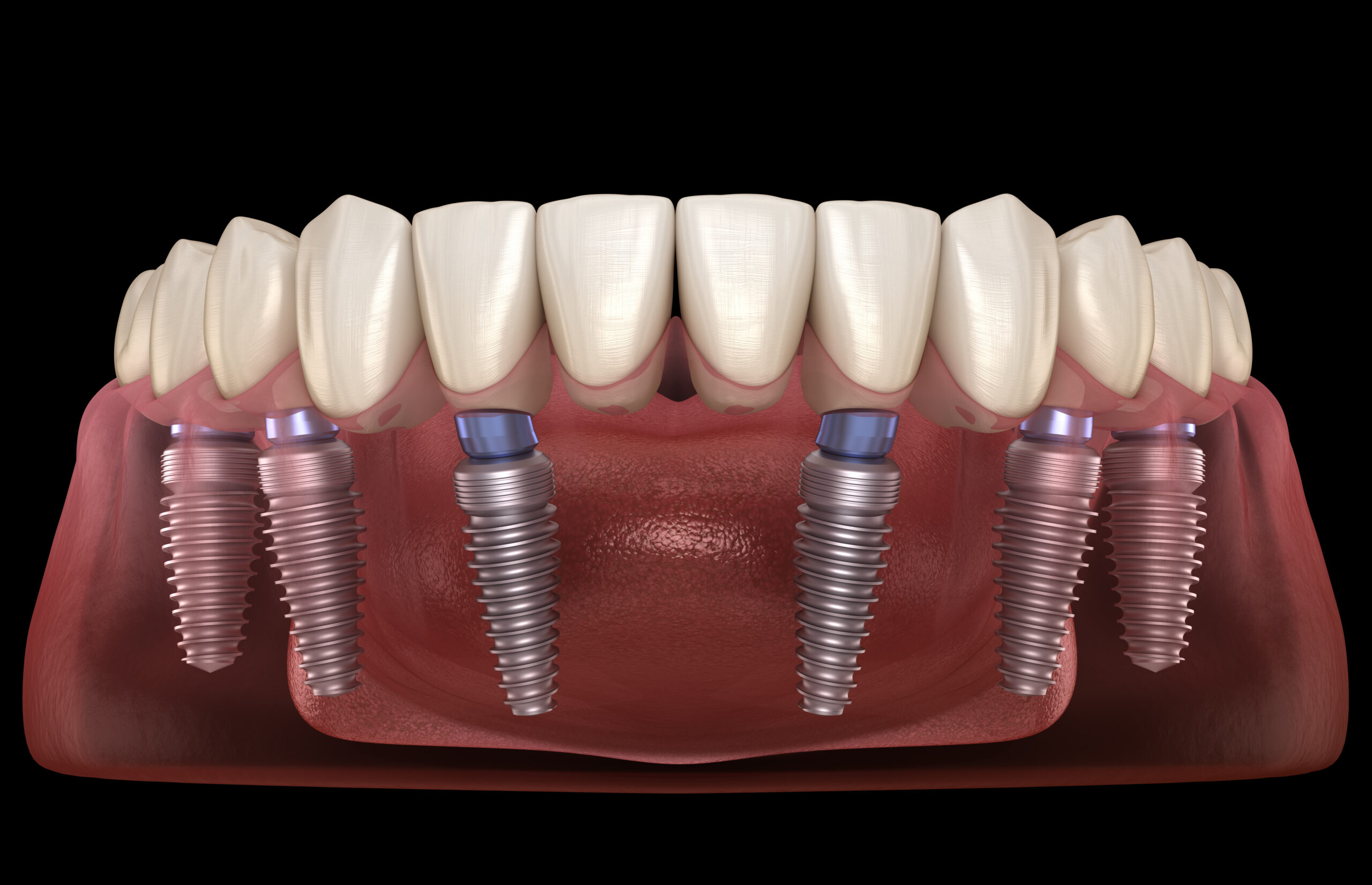 an image of all-on-6 dental implants model.
