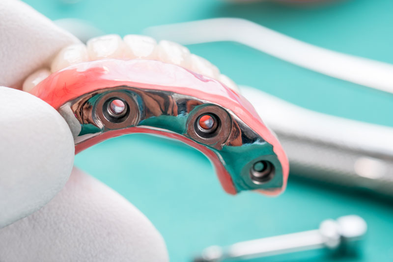 Elevate Your Oral Health with Implant Supported Dentures in Fort Lauderdale, FL