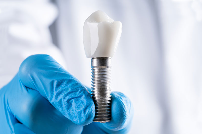 a dental professional holding up a single dental implant, for a dental implant procedure, that is composed of a dental implant post, an abutment, and a tooth crown.