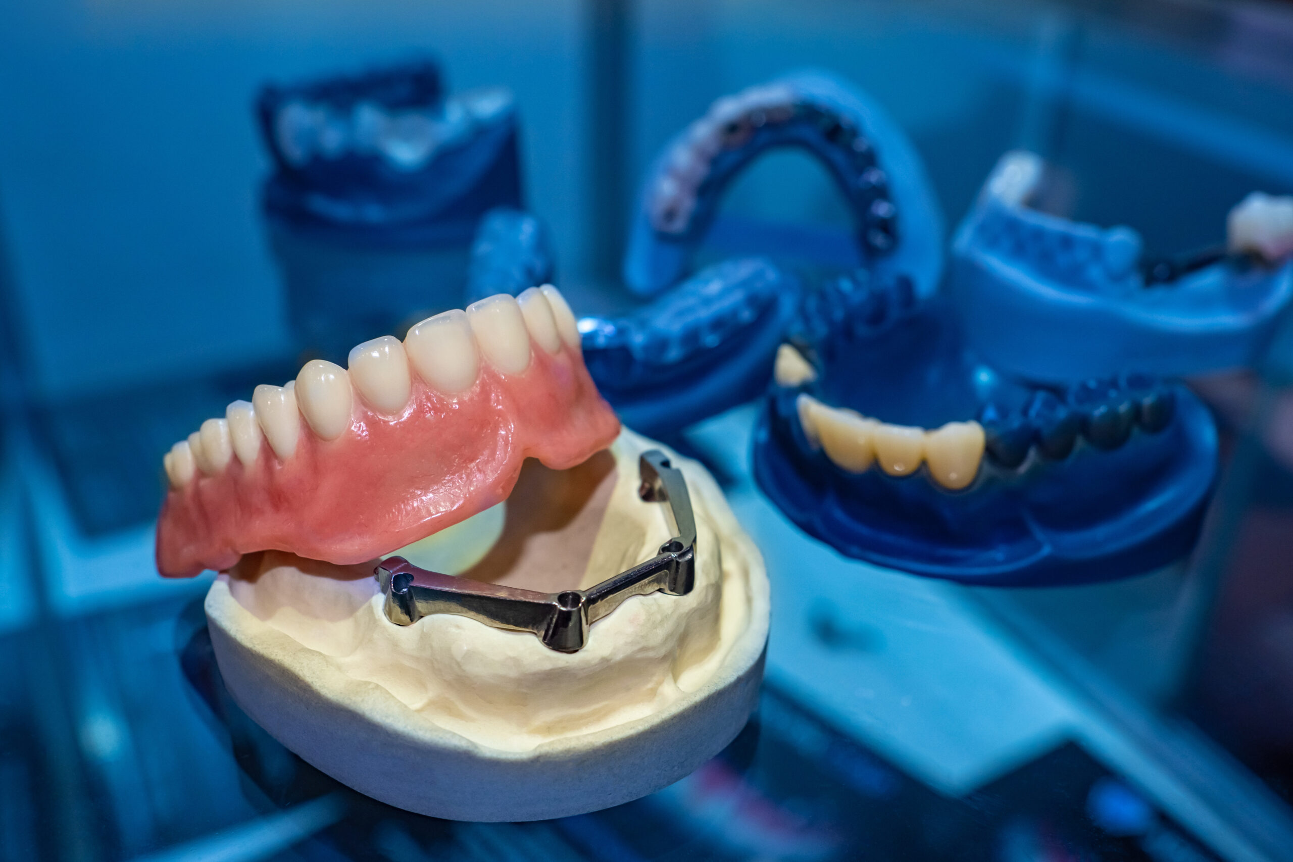 image of a dental implant denture on a prosthesis jaw in a dark and blue lit aesthetic dental room image of a dental implant denture on a prosthesis jaw in a dark and blue lit aesthetic dental room.