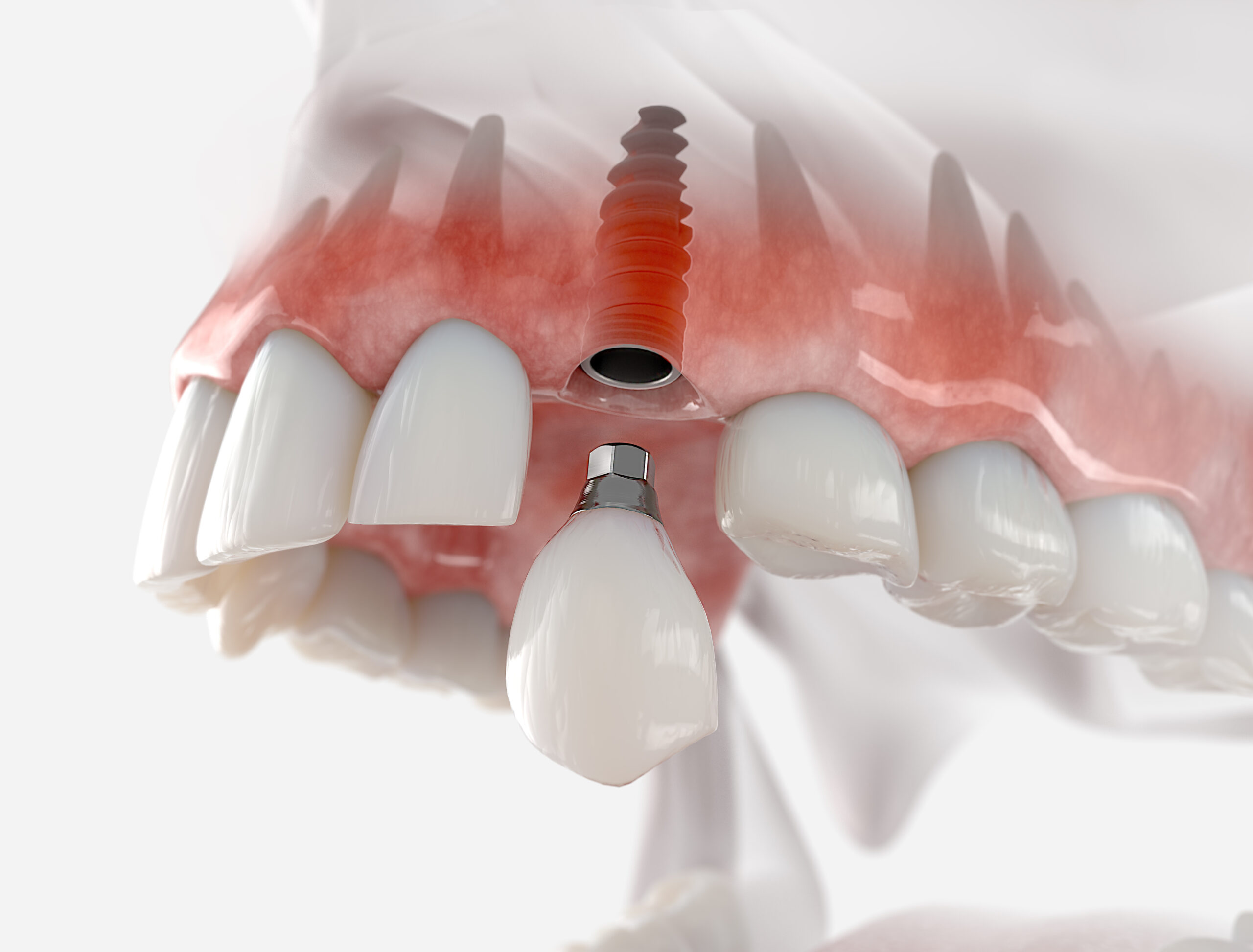 Interested In Dental Implants In Fort Lauderdale, FL? These Are The Types Of Dental Implants You Can Get Treated With