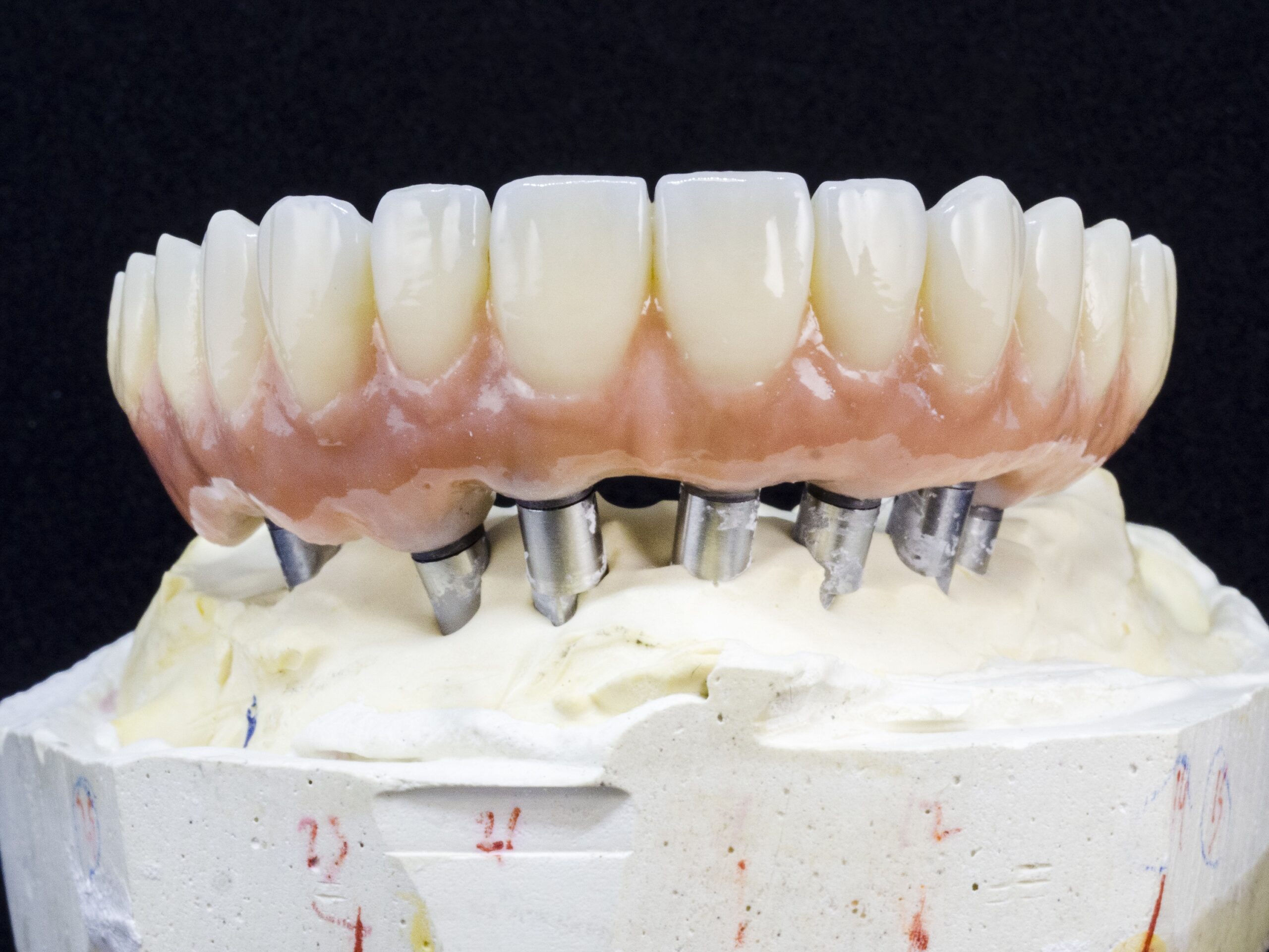 Can I Get Treated With Implant Supported Dentures In Fort Lauderdale, FL?