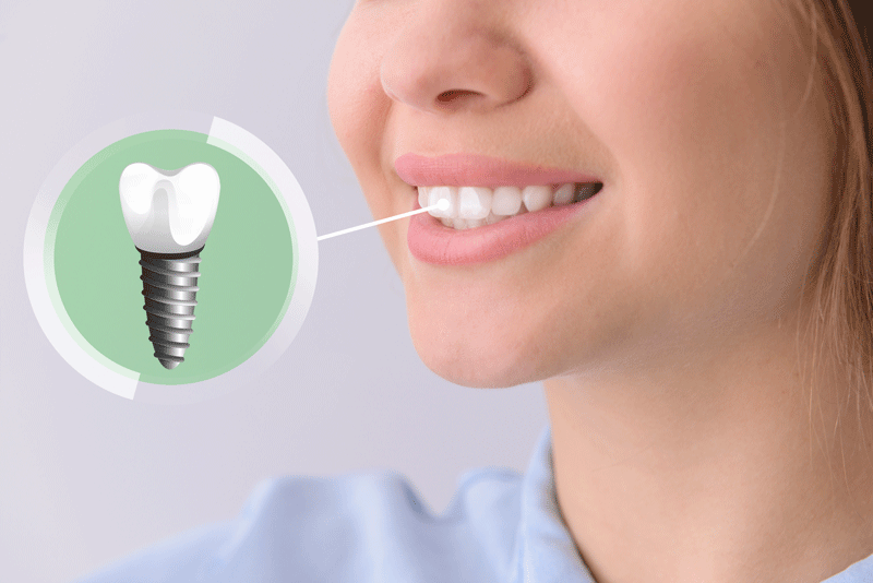 Can I Upgrade My Smile From Traditional Dentures To Implant Supported Dentures?