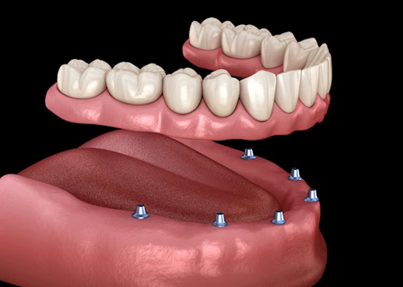 an image of dental implants.