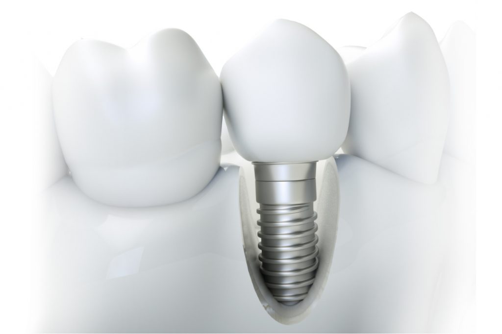 Questioning What Determines The Cost Of Dental Implants In Fort Lauderdale, FL? This Is What Determines It