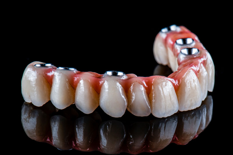 acrylic full arch