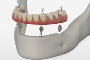 full arch dental implants photo