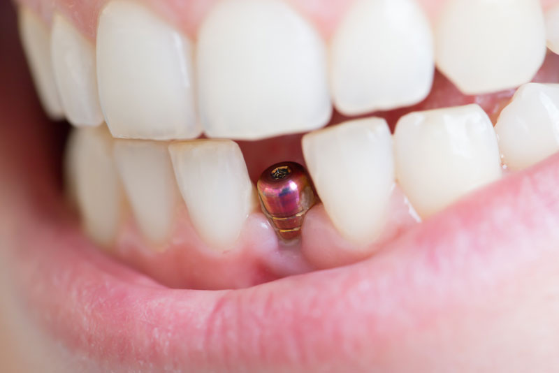 dental implants post in mouth example