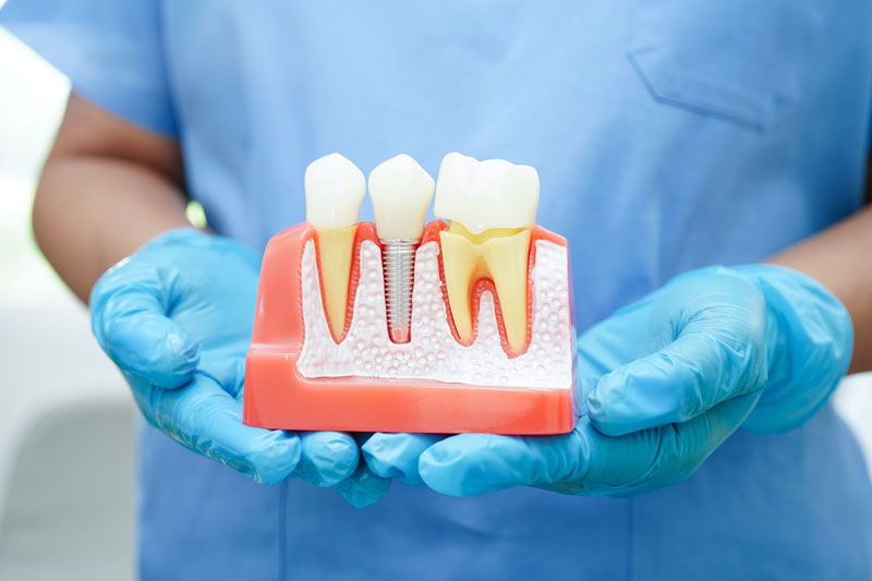 Understanding Dental Implants: Procedures, Benefits, and Innovations for a New Smile
