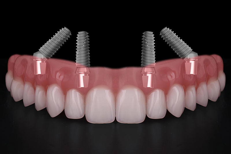 Understanding All-on-4 Dental Implants in Sunrise FL: A Comprehensive Oral Surgery Guide