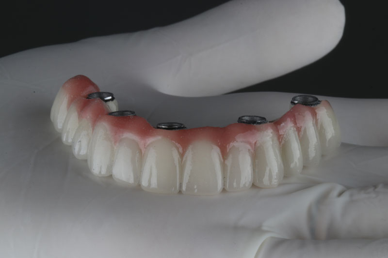 Rebuilding Smiles: Full Mouth Reconstruction Options in Fort Lauderdale, FL