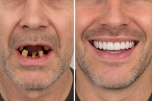 A before and after image of a patient who has undergone full mouth dental implants. The before image shows broken and missing teeth, while the after image shows a full, healthy smile with dental implants. No text on the image.