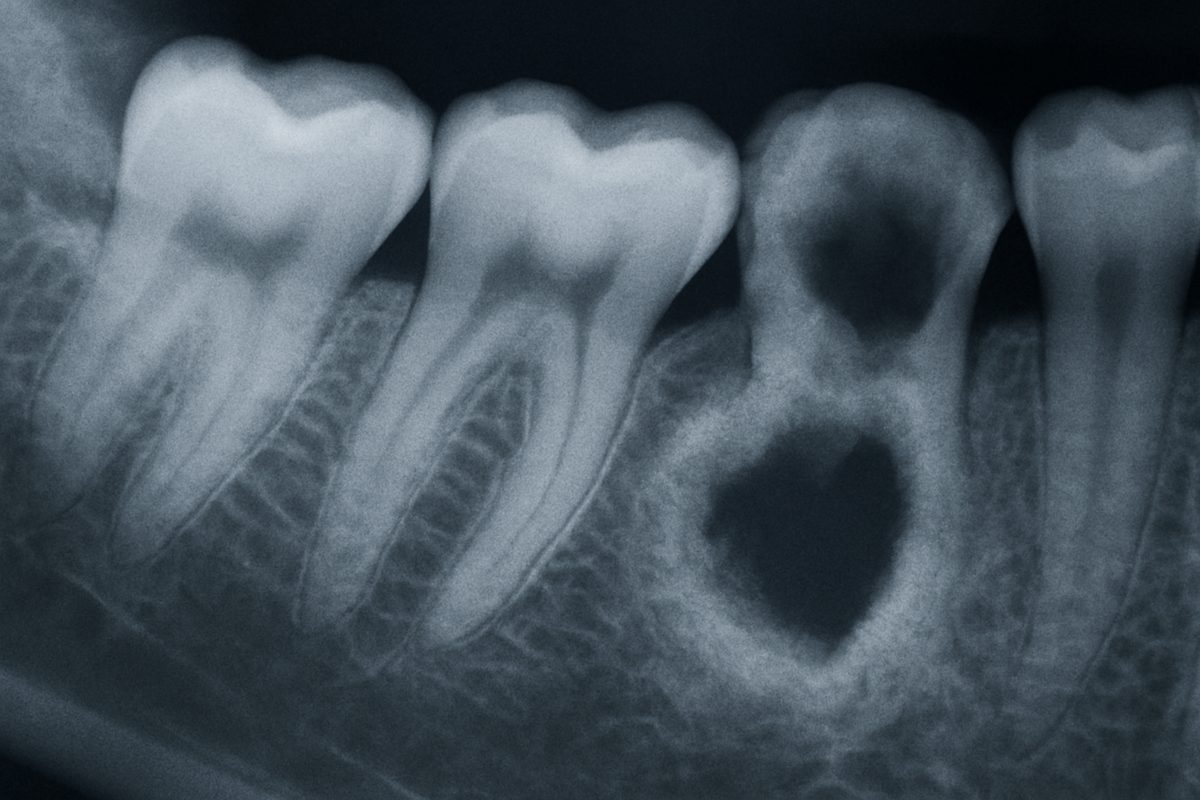 A close up x-ray of a mouth showcasing an example of "dental har" with an obvious infection around the tooth. No text on image.